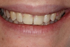 Smile transformation on the day of brace removal- what a difference!