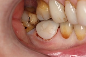 After Waterlase crown lengthening- minimal trauma, gentle on the tissues