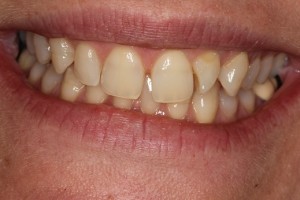 Our patient hated the twisted tooth, the gaps and the size of the teeth