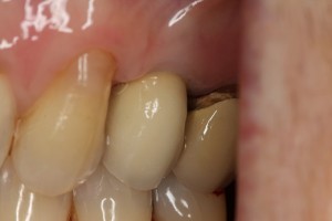 Dental implant placed and new implant crown. Note the natural appearance.