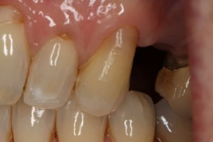 Missing premolar tooth- large space present and loss of function