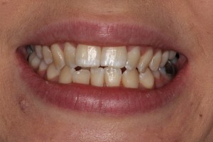 Before treatment. A narrow smile and note how the back teeth are slanting inwards