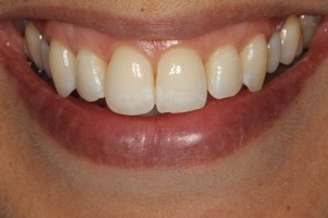 Straight teeth using invisible braces