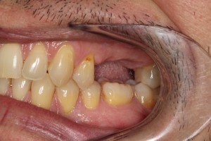 Missing teeth, large gap and unable to bite properly