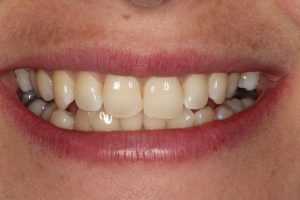 Straight front teeth in just 3 visits!