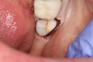 A lower tooth that has just had crown lengthening using the Waterlase i Plus- note no bleeding and no stitches