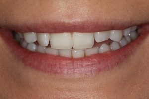 Slightly crooked teeth and short lateral incisor teeth