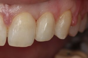 a brand new tooth after cosmetic bonding