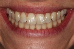 Crooked front teeth