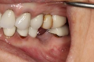 Missing molar tooth- note how the bite is affected