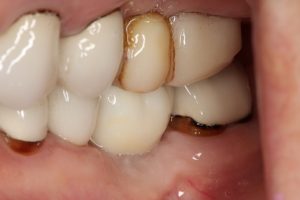 All ceramic zirconium implant crown. Natural, aesthetic and function regained