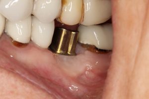 Gold customised abutment placed within implant to secure the crown.
