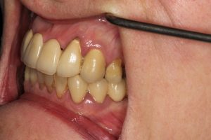 after-dental-implant
