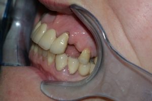 before-dental-implant