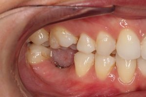 Missing molar tooth- a big space and lack of function