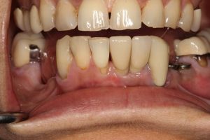 After dental implant- life like and aesthetic replacement dental implant crown