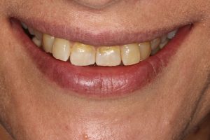 We struggled to get our patient to smile. Teeth sticking out, heavy wear and discolouration