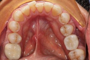 The molar dental implant- function is restored to normal