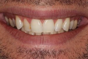 Before treatment- crooked teeth and uneven smile line