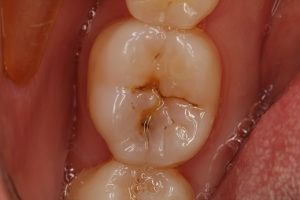 Tooth decay present on a back tooth