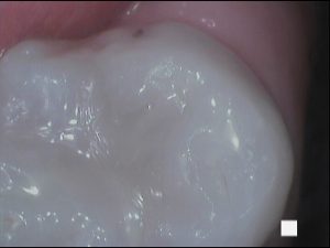 Tooth restored after fluid abrasion and sealant