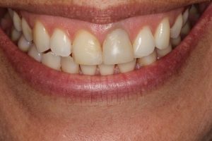 Before porcelain veneers. Discoloured teeth, badly built up in composite and asymmetry