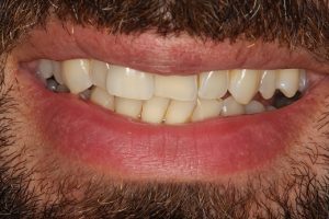 Before Social 6 lingual brace, teeth whitening and cosmetic bonding