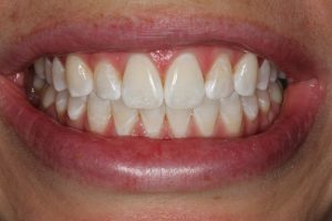 After Philips ZOOM LED whitening