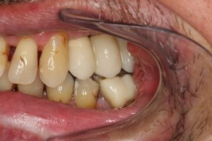 After dental implants, missing back left teeth restored