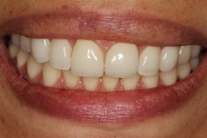 The existing veneers were bulbous, uneven and cracking.
