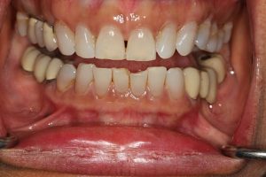 Lower front teeth heavily worn down