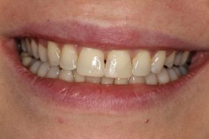 Teeth are now even with cosmetic bonding; natural and life like. A lovely smile.