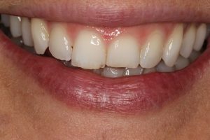 After a full arch lingual brace- straight teeth but the wear is evident