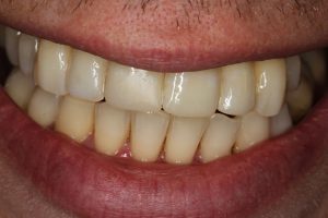 After a combination of orthodontics, tooth whitening and cosmetic bonding. WOW!