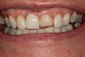 Before smile transformation- failing veneers and a bulky dental implant