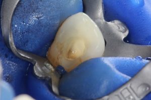 Root canal access made using the Waterlase i Plus laser