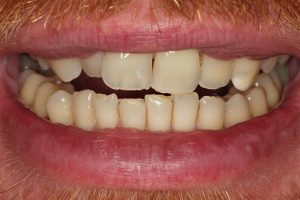 Teeth crowding and uneven edges