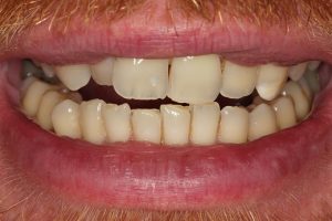 Teeth crowding and uneven edges