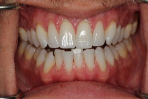 Before lingual braces; the upper lateral teeth are slightly behind the central and the lower teeth are heavily crowded