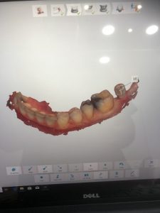 3-D intra oral scan