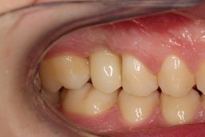 Implant tooth - natural and function is restored