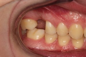 Missing back tooth, affects the bite and normal function