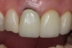 Front tooth crown which has a dark line due to gum recession. The underyling tooth is dead and very discoloured.