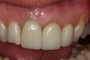 Fully customised crown in situ. Fully finished with a natural and aesthetic outcome. Now the adjacent tooth needs replacing!