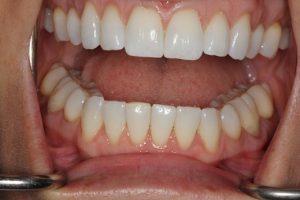 After treatment using the Social 6 lingual brace. Straight front teeth and even edges.