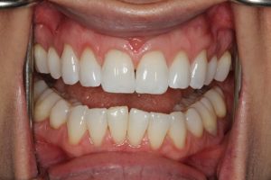 Lower front teeth are crooked and uneven in height.
