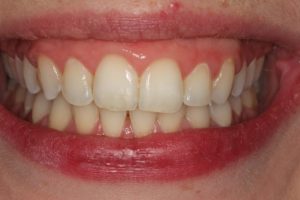 straight teeth, cross bite corrected, arch development & symmetry