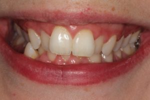 smile with severe crowding, cross bite on lower canine & non visible buccal corridors