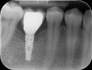 Bone loss around the front & back of the dental implant x-ray