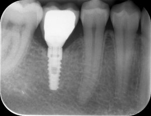 Full healing & regeneration. The bone levels are now back to normal with in fill of the dark voids seen x-ray